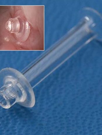 Stoploss systeme anti reflux