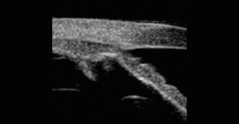 Vumax glaucoom management