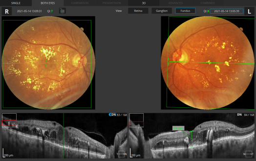 Retina 3 D Both Eyes Fundus View